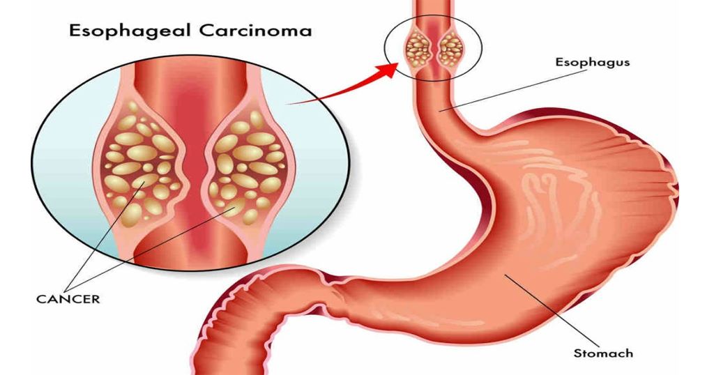 Esophagus Cancer Treatment in Bangalore