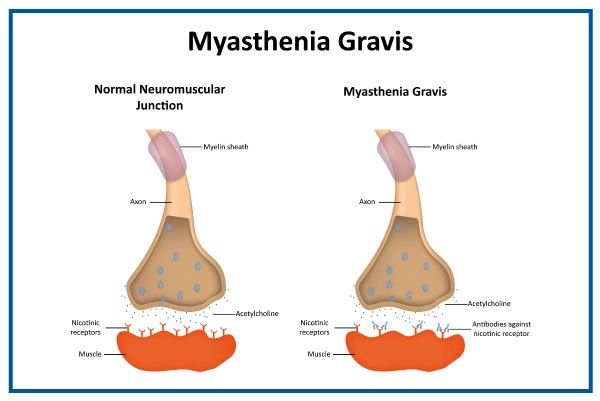 Myasthenia Gravis Treatment in Bangalore