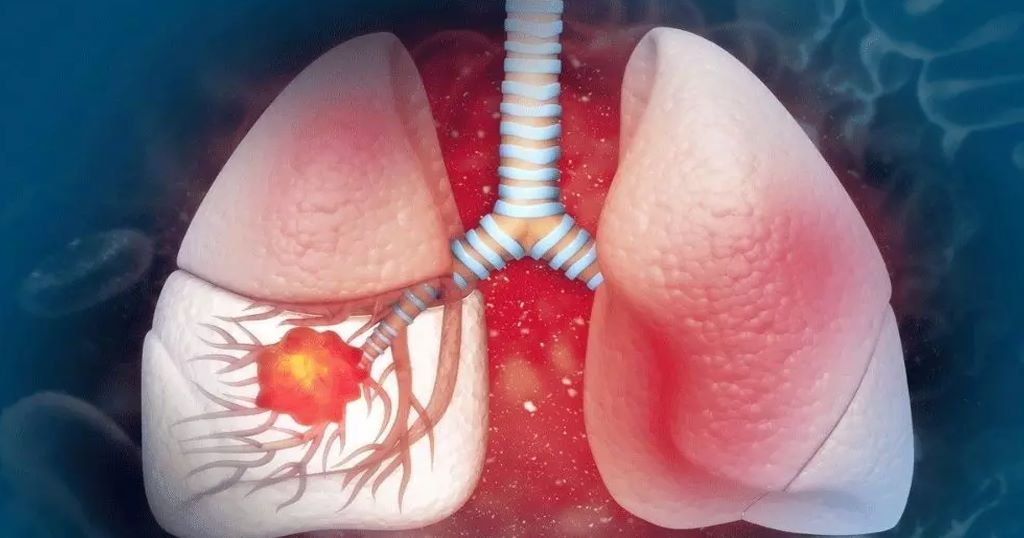 Lung Cancer Treatment in Bangalore