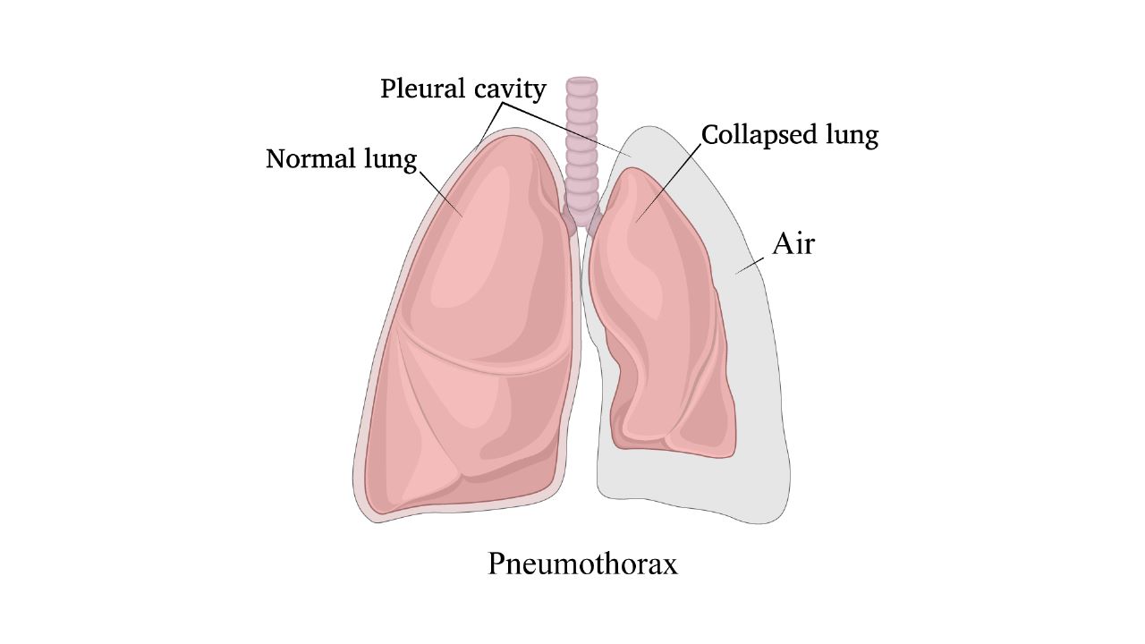 Pneumothorax Treatment in Bangalore