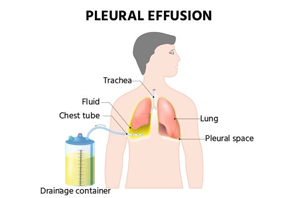 Pleural Effusion Treatment in Bangalore 