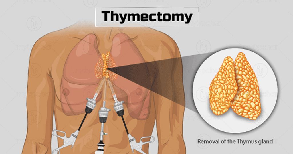 Thymoma Treatment in Bangalore