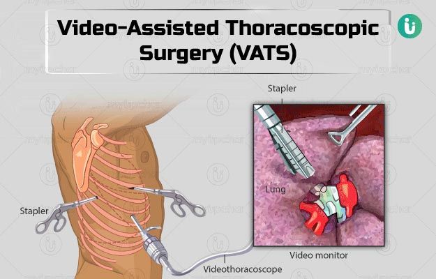 Video Assisted Thoracic Surgery in Bangalore 